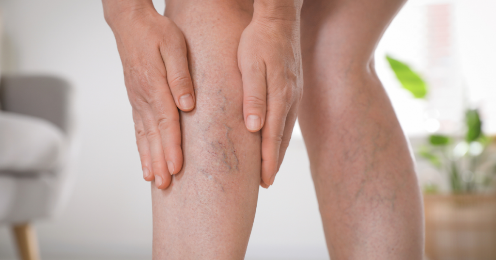 Tipos de tratamento para varizes_ qual o ideal para você